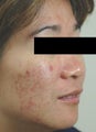 Laser Acne Scar Removal