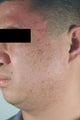 Laser Acne Scar Removal
