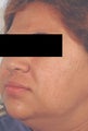 Acne scar treatment