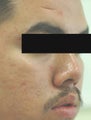 Acne Scar Treatment