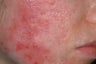 Acne scar treatment