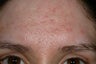 Acne scars