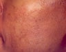 Blue Light for Acne