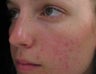 PDT for acne treatment