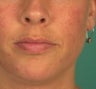 PDt for acne treatment