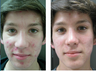 Acne Treatment