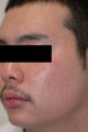 Laser Acne Treatment
