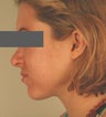 Laser Acne Treatments