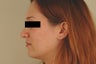 Laser Acne Treatment