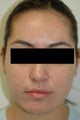 Laser Acne Treatment