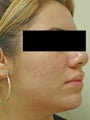 Laser Acne Treatment
