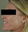 Laser Acne Treatment