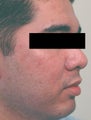 Laser Acne Treatment