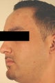 Laser Acne Treatment