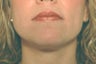Laser Acne Treatment