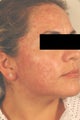 Laser Acne Treatment
