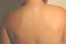 Laser Back Acne Treatment