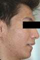 Laser Acne Treatment