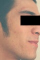 Laser Acne Treatment