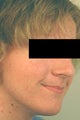 Huntington Beach Acne Treatment Before and After