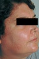 Laser Acne Treatment