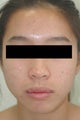 Laser Acne Treatment