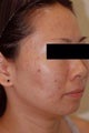 Laser Acne Treatment