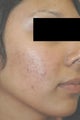 Laser Acne Treatment