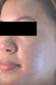 Laser Acne Treatment