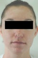 Laser Acne Treatment