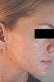 Laser Acne Treatment