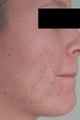Laser Acne Treatment