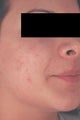 Laser Acne Treatment