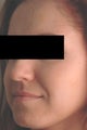 Hormonal Acne Treatment in Los Angeles