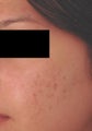 Laser Acne Treatment