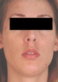 Laser Acne Treatment