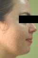 Laser Acne Treatment