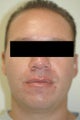 Laser Acne Treatment