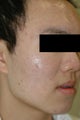 Laser Acne Treatment