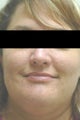 Laser Acne Treatment