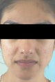 Laser Acne Treatment