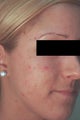 Laser Acne Treatment