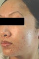Laser Acne Treatment