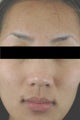 Laser Acne Treatment