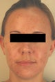 Laser Acne Treatment