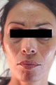 Laser Acne Treatment