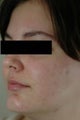 Laser Acne Treatment
