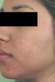 Laser Acne Treatment