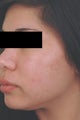Laser Acne Treatment