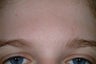 Laser acne treatment with Cooltouch